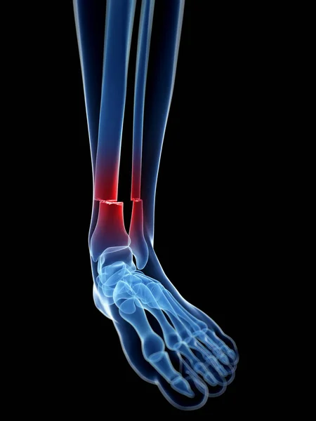 Ilustracja Medyczna Złamanej Kości Nogi — Zdjęcie stockowe
