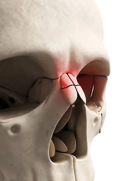 Lékařské Ilustrace Zlomeného Nosu — Stock fotografie