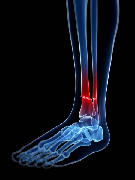 Lékařské Ilustrace Zlomené Nohy Kosti — Stock fotografie