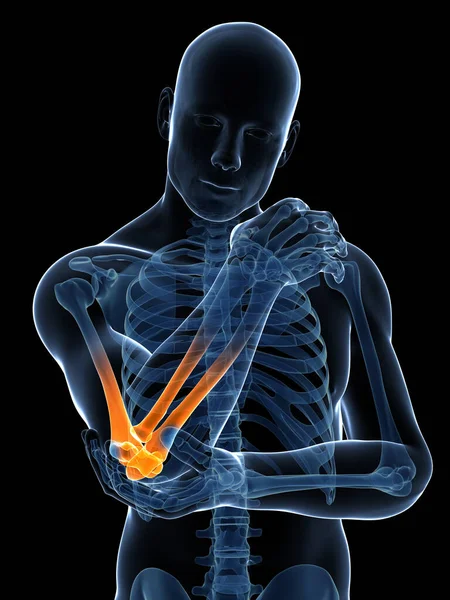 Τετηγμένα Εικονογράφηση Του Πόνου Στον Αγκώνα — Φωτογραφία Αρχείου