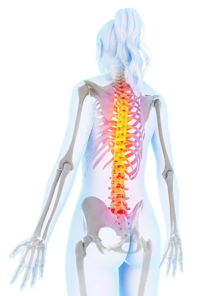 Gerenderte Illustration Eines Schmerzhaften Rückens — Stockfoto