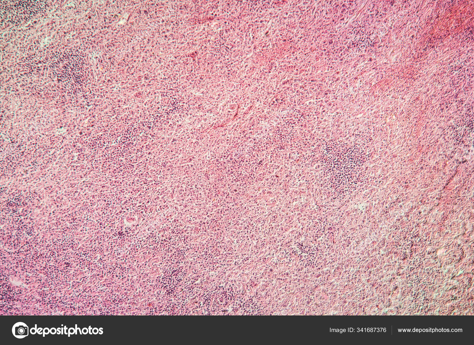 Лимфоидная Ткань Миелиновая Саркома Пораженная Ткань 100X стоковое фото ...
