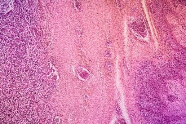 Amigdalită Țesut Bolnav 100X — Fotografie, imagine de stoc