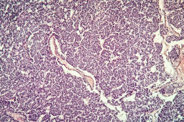 Cancer Metastases Diseased Tissue 100X — Stock Photo, Image