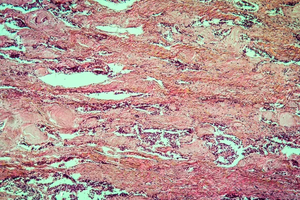 Carcinome Scirragique Thyroïde Tissus Malades 100X — Photo
