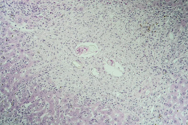 Rato Fígado Tecido Doente 100X Esquistossomose — Fotografia de Stock