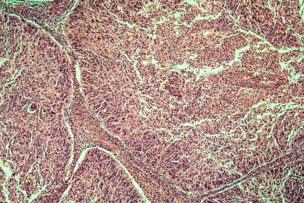 Carcinoma Cervicale Tessuto Malato 100X — Foto Stock