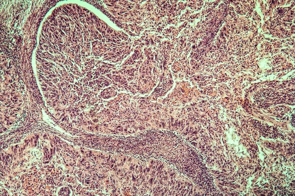 Nyaki Carcinoma Beteg Szövet 100X — Stock Fotó