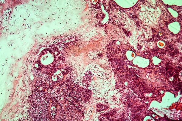 Tumor Misto Glândula Parótida Tecido Doente 100X — Fotografia de Stock