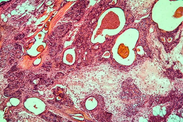 腮腺病变组织100X混合性肿瘤 — 图库照片