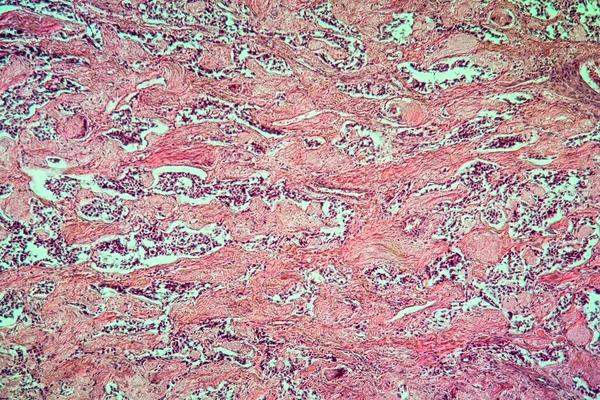 Fibromioma Buen Tumor Del Tejido Enfermo Del Útero 100X — Foto de Stock