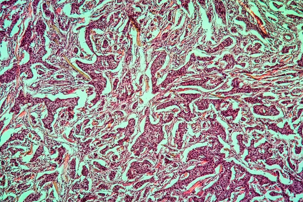 Рак Молочної Залози Хвора Тканина 100Х — стокове фото