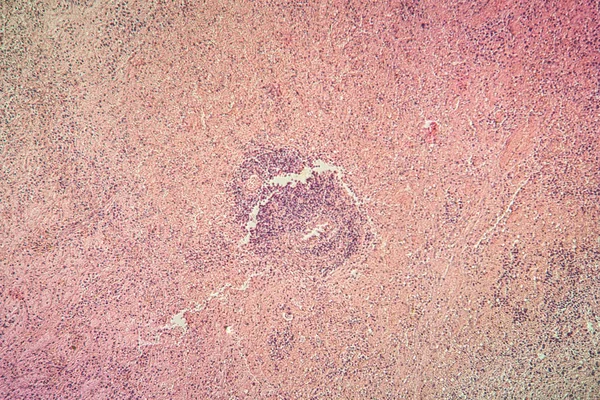 Narben Herzmuskel 100X Der Herzschwielen Unter Dem Mikroskop — Stockfoto