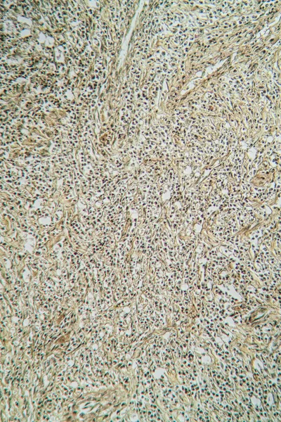 Enfermedad Bajo Microscopio 100X —  Fotos de Stock