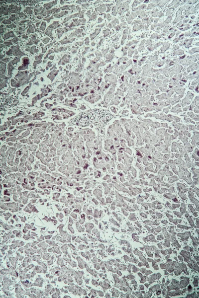 Diseased Tissue Microscope 100X — Stock Photo, Image