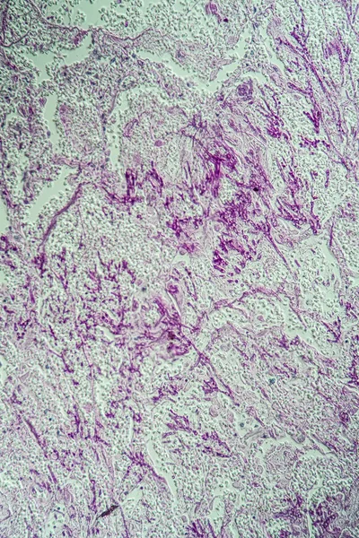 Λοίμωξη Candida Και Aspergillus 200X — Φωτογραφία Αρχείου