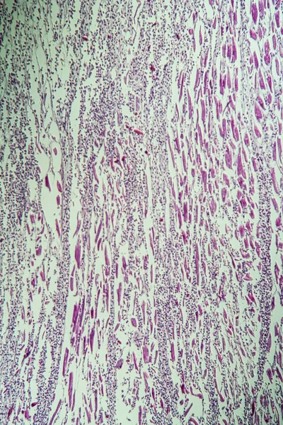 Tejido Miocarditis Bajo Microscopio — Foto de Stock