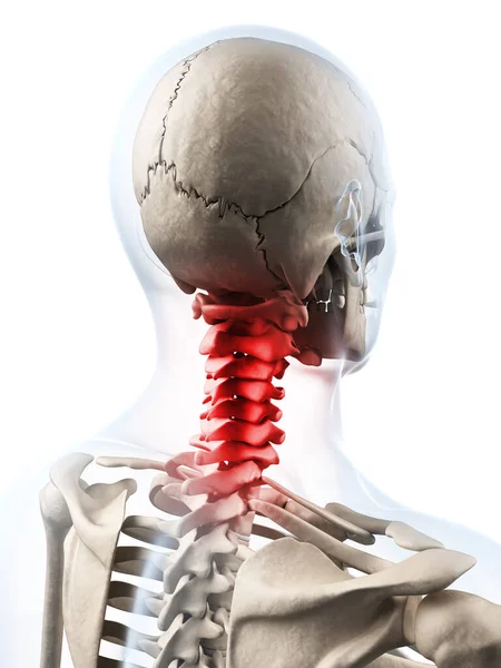 痛み首の レンダリングされた図 — ストック写真