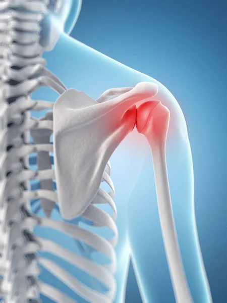 Inflamed Human Shoulder Joint — Stock Photo, Image