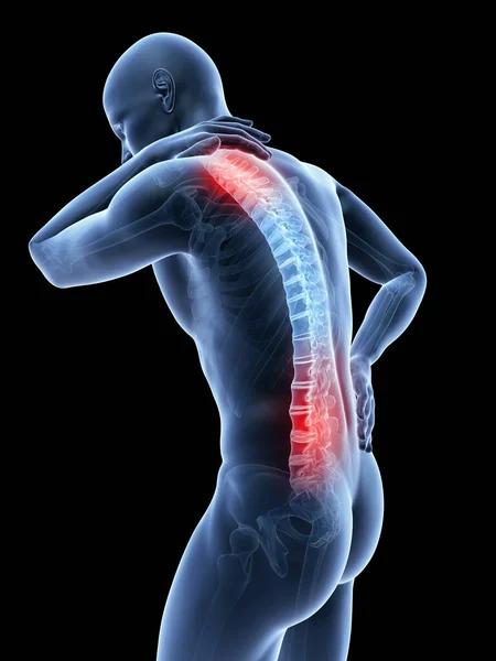 Representada Ilustración Hombre Que Tiene Una Espalda Cuello Dolorosos —  Fotos de Stock