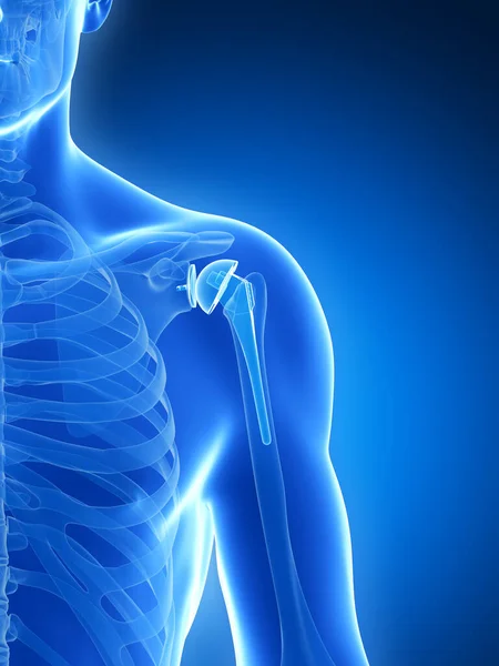 Rendered Illustration Shoulder Replacement — Stock Photo, Image