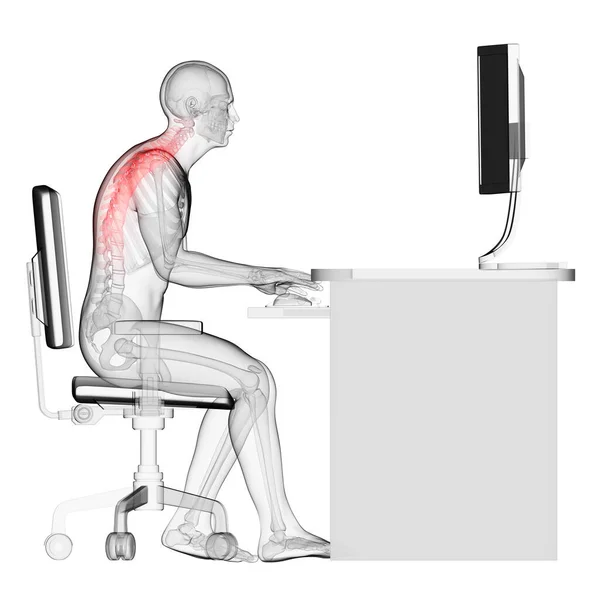 Gerenderte Medizinische Illustration Falsche Sitzhaltung — Stockfoto