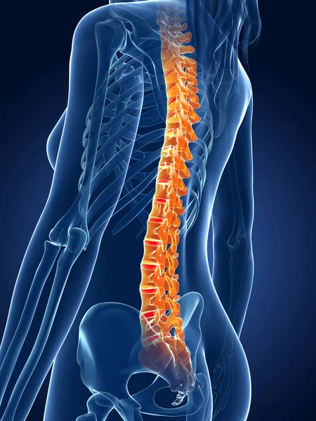 Kiolvasztott Orvosi Illusztráció Fájdalmas Gerinc — Stock Fotó
