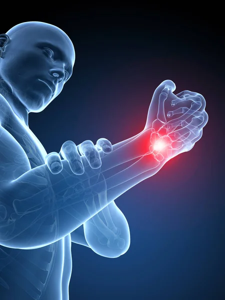Gerenderte Medizinische Illustration Schmerzhaftes Handgelenk — Stockfoto