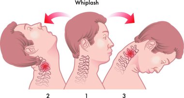 vector medical illustration of the dynamics of the whiplash injury clipart