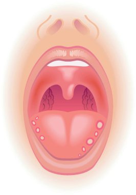 medical illustration of symptoms of tongue sores clipart