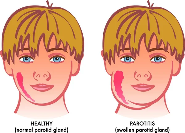 Vector Medical Illustration Showing Healthy Child Next Suffering Parotitis Inflammation — Stock Vector