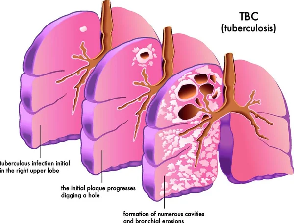 Vetor Ilustração Médica Dos Sintomas Tuberculose — Vetor de Stock