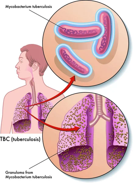 Vektor Medicinsk Illustration Symtom Tuberkulos — Stock vektor