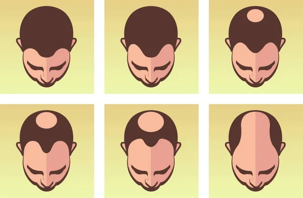 Eine Vektorillustration Die Verschiedene Stadien Des Männlichen Haarausfalls Zeigt — Stockvektor