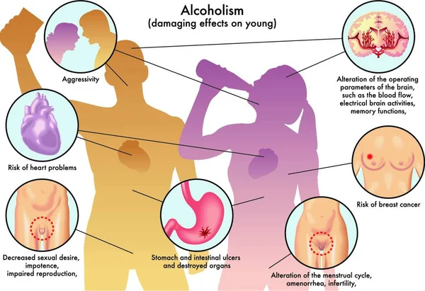 Vector Médico Ilustración Los Daños Causados Por Alcohol Los Jóvenes — Vector de stock