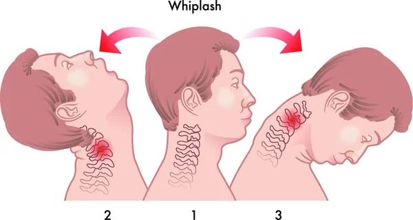 Vektor Medicinsk Illustration Dynamiken Whiplash Skada — Stock vektor