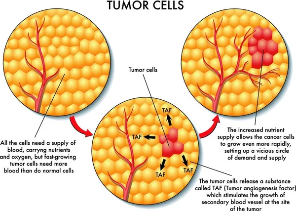 Διανυσματική Ιατρική Απεικόνιση Του Σχηματισμού Των Καρκινικών Κυττάρων — Διανυσματικό Αρχείο