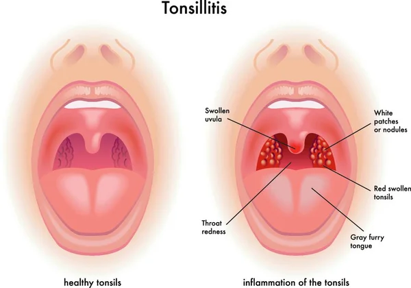 Ilustración Médica Los Síntomas Amigdalitis — Vector de stock