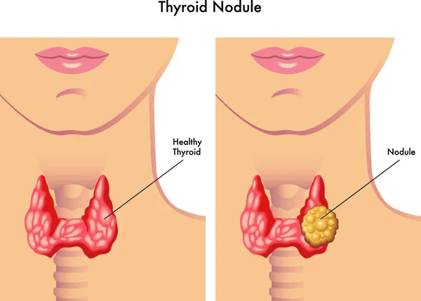 Medical Illustration Showing Healthy Woman Woman Thyroid Nodule — Stock Vector