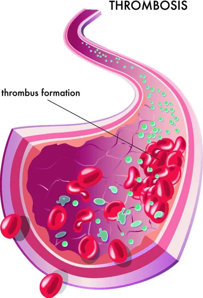 Medicinsk Illustration Bildandet Tromb — Stock vektor