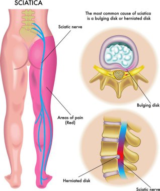 medical illustration of symptoms of sciatica clipart