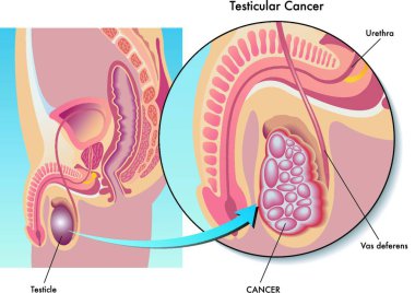 medical Illustration of the symptoms of testicular cancer clipart