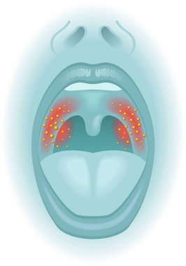 medical illustration of the symptoms of sore throat clipart