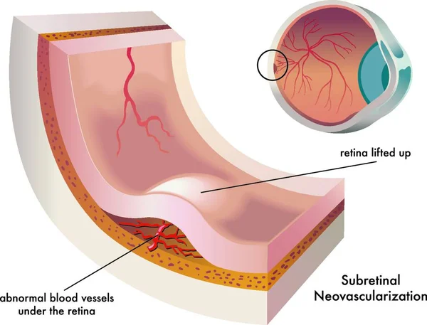 Ilustração Médica Formação Uma Neovascularização Subretina Olho — Vetor de Stock