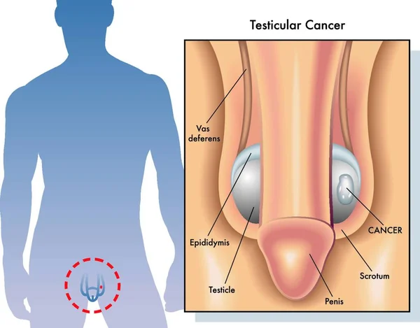 Ilustración Médica Los Síntomas Del Cáncer Testicular — Vector de stock