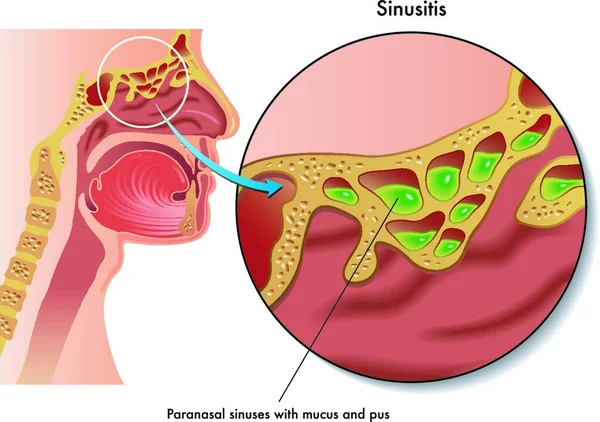 Medizinische Illustration Der Symptome Der Sinusitis — Stockvektor