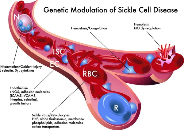 Медицинская Иллюстрация Генетической Модуляции Серповидно Клеточной Болезни — стоковый вектор