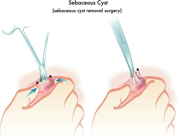 Illustration Médicale Une Excision Kyste Sébacé — Image vectorielle