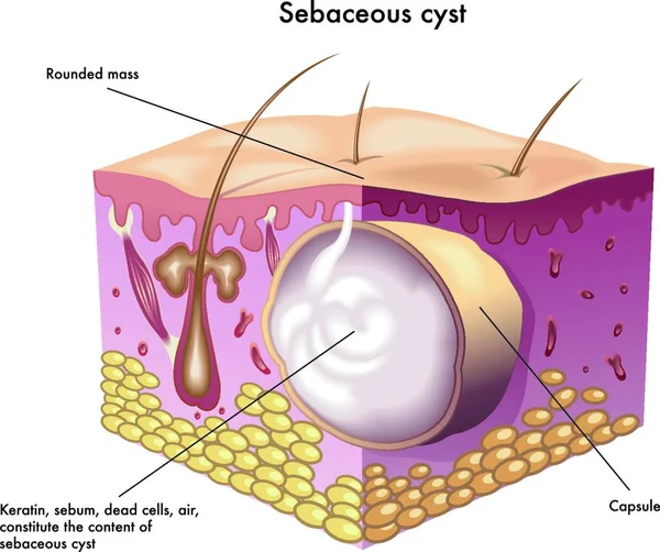 Ilustração Médica Secção Pele Com Cisto Sebáceo — Vetor de Stock