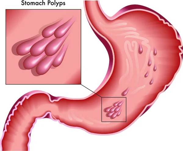 Dibujo Médico Ilustrado Del Estómago Con Pólipos — Vector de stock